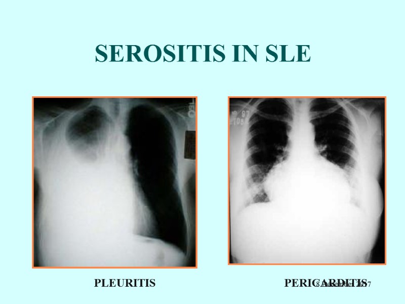 SEROSITIS IN SLE PLEURITIS          